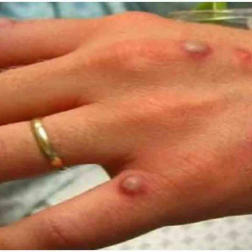 गाजियाबाद में 5 साल की बच्ची में मिले मंकीपॉक्स जैसे लक्षण, जांच के लिए पुणे लैब भेजे गए सैंपल 1 Untitled design 2022 06 05T000248.552